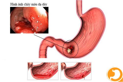 Có những biện pháp phòng tránh và ngăn chặn biến chứng xuất huyết tiêu hóa như thế nào?
