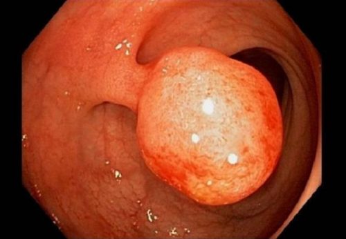 Polyp là một hay nhiều khối u lồi xuất hiện trên lớp niêm mạc phía bên trong trực tràng. 