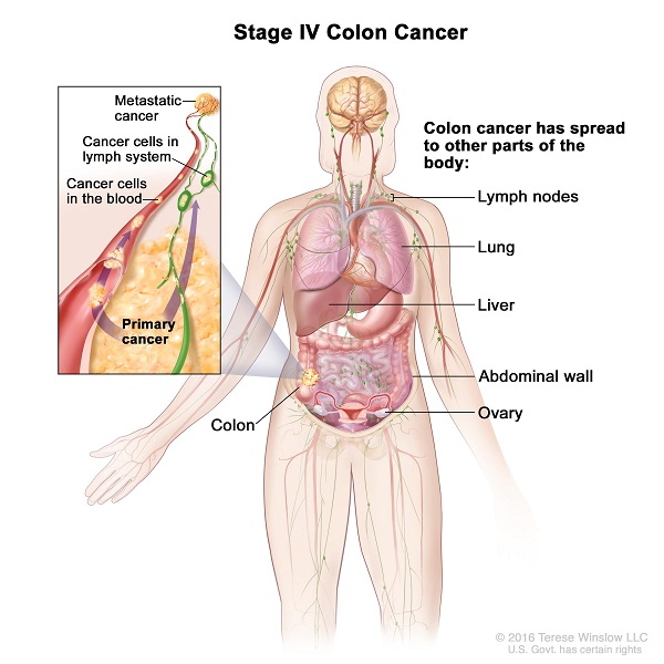 Ung thư đại tràng giai đoạn cuối có khả năng di căn đến nhiều cơ quan ở xa