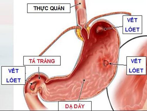 Nguyên nhân và cách xử lý tình trạng bụng đau âm ỉ chướng bụng