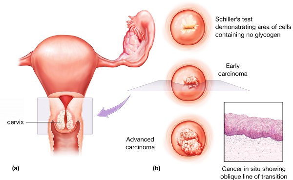 Ung thư cổ tử cung là bệnh lý nguy hiểm cần được phát hiện và điều trị càng sớm càng tốt