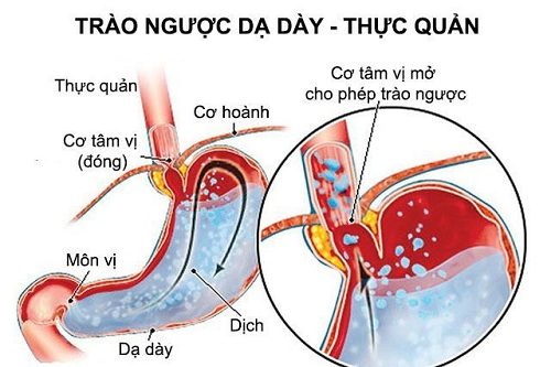 Bệnh trào ngược dạ dày có thể gây ra các biến chứng nguy hiểm nếu không được điều trị kịp thời, đúng phương pháp