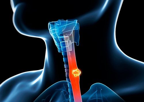 Ung thư thực quản là biến chứng nguy hiểm của bệnh trào ngược dạ dày