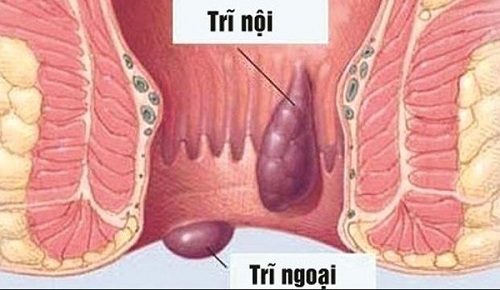 Bệnh trĩ ngoại rất dễ nhận biết, người bệnh có thể nhìn hay sờ thấy búi trĩ bằng mắt thường