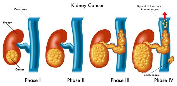 Các giai đoan ung thư thận bạn cần biết