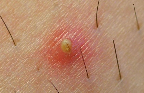 Các loại mụn mọc ở vùng kín
