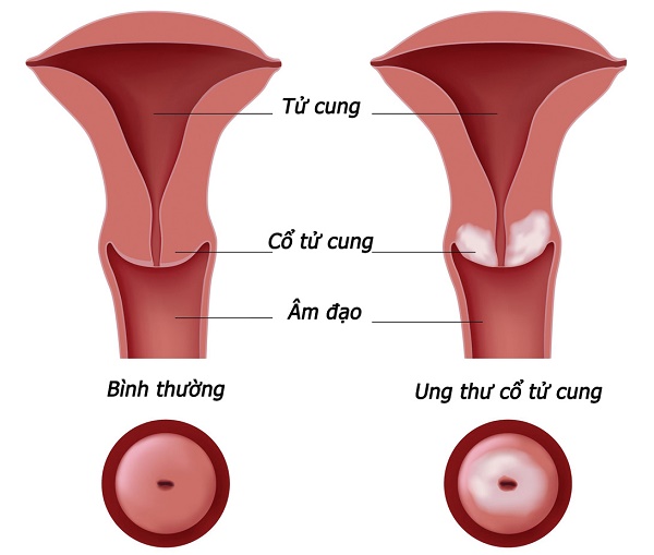 Các loại phẫu thuật ung thư cổ tử cung | TCI Hospital