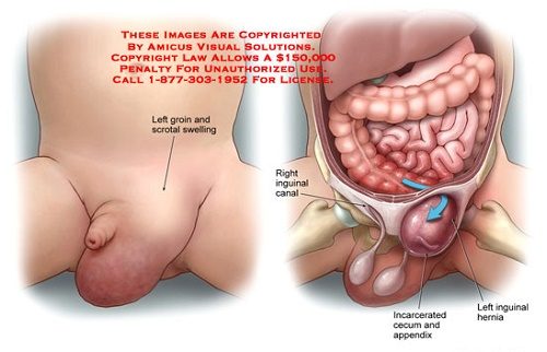 Thoát vị bẹn là tình trạng một phần cơ quan trong ổ bụng như ruột, mạc nối chui vào lỗ bẹn tạo thành túi thoát vị. 