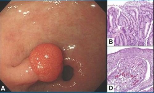 Cách điều trị polyp dạ dày: Giải pháp hiệu quả và an toàn cho sức khỏe dạ dày