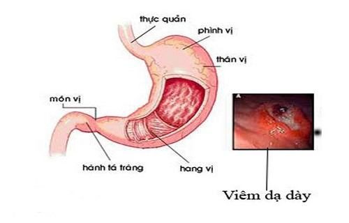 Cách áp dụng phác đồ điều trị viêm dạ dày mạn tính thiếu hiểu biết và cách điều trị