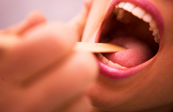 điều trị viêm họng mạn tính