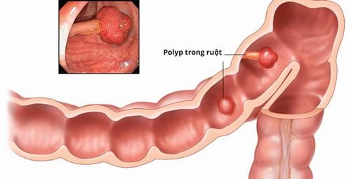 Polyp đại tràng là bệnh thường gặp do nhiều nguyên nhân khác nhau gây ra như chế độ ăn uống, di truyền