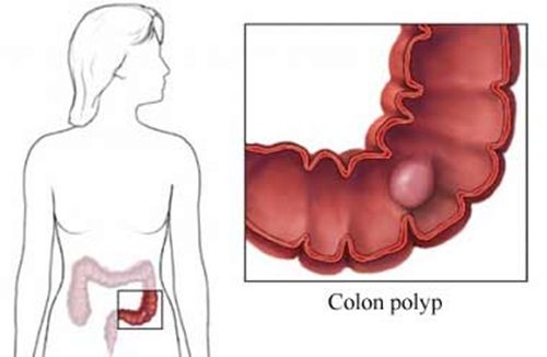 Polyp đại tràng có thể phát triển thành ung thư đại tràng. Vì vậy người bệnh cần có phương ăn cắt Polyp đại tràng.
