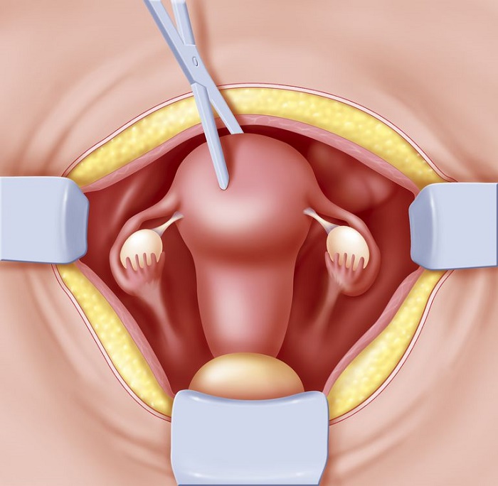 Cắt tử cung là phương pháp dùng để điều trị một số bệnh phụ khoa hoặc ung tư tử cung, cổ tử cung.