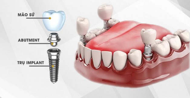 Trồng răng bằng cấy ghép implant là gì? | TCI Hospital