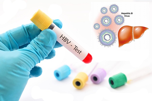 Xét nghiệm chẩn đoán viêm gan B ban đầu gồm xét nghiệm HBsAg và Anti-HBs