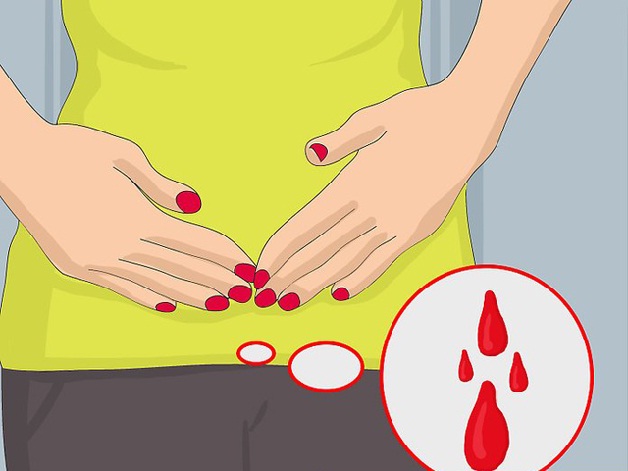 Chảy máu âm đạo là dấu hiệu chửa ngoài tử cung