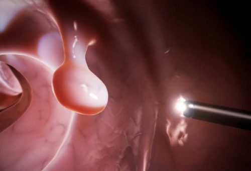 Polyp dạ dày là khối tế bào hình thành trên lớp lót bên trong dạ dày.