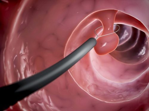 Đối những polyp có kích thước lớn cần phải được tiến hành phẫu thuật cắt bỏ để tránh biến chứng ung thư