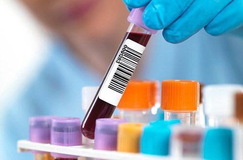 Xét nghiệm máu tìm chất chỉ điểm CA 72-4 giúp chẩn đoán sớm ung thư dạ dày