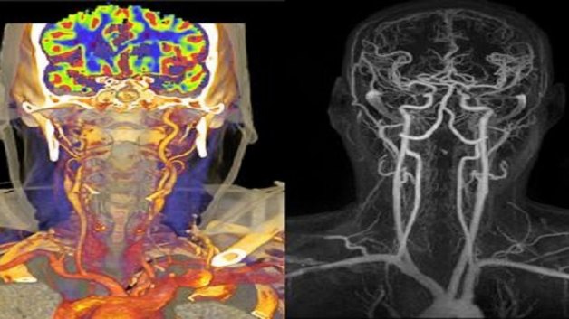 Chụp cắt lớp vi tính mạch máu não là gì 
