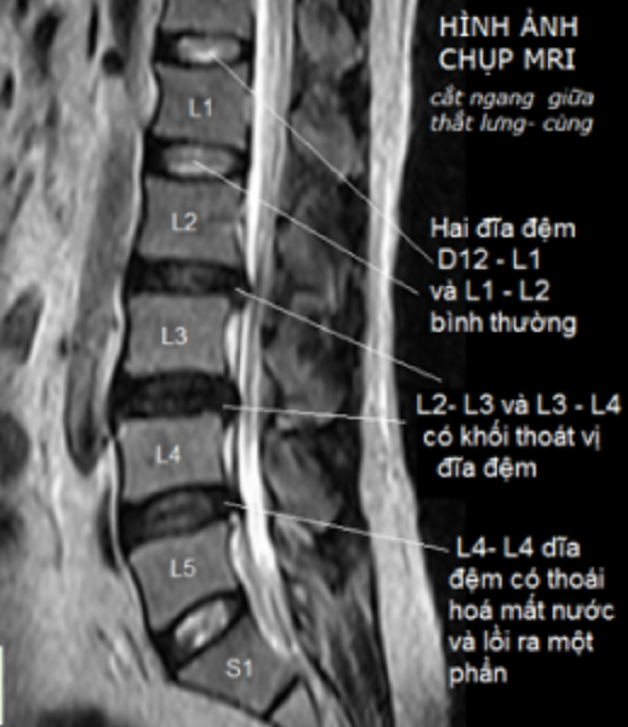 Nên chụp cộng hưởng từ cột sống thắt lưng khi nào? | TCI Hospital