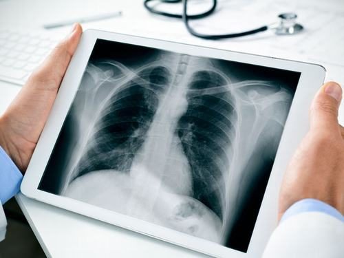 Chụp X quang là phương pháp chẩn đoán hình ảnh được sử dụng rộng rãi để phát hiện những bất thường, tổn thương ở xương, răng, mô đặc... 