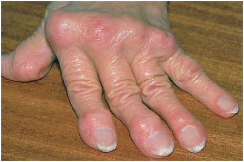 Gout là bệnh gì?
