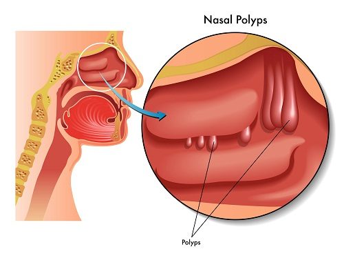 Polyp dạ dày là khối các tế bào hình thành ở lớp niêm mạc trong dạ dày, rất hiếm gặp.