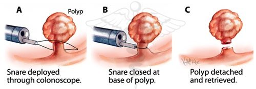 Hiện nay, polyp dạ dày hiện được cắt bỏ nhẹ nhàng bằng kỹ thuật nội soi qua đường miệng. Thủ thuật nhẹ nhàng như 1 ca nội soi thông thường và bệnh nhân được ra về sau khi 1 - 2 tiếng phẫu thuật.