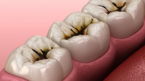 Có nên nhổ răng sâu không hay có thể giữ lại?