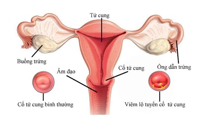 Hình ảnh mô phỏng cổ tử cung ở phụ nữ