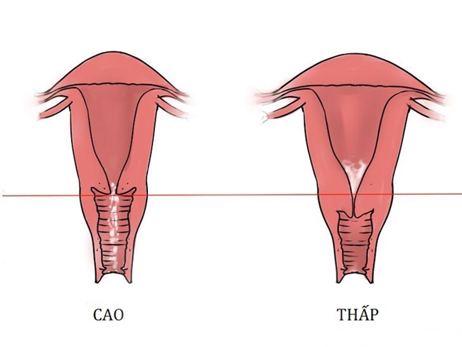 Cổ tử cung cao có ảnh hưởng tới khả năng mang thai? | TCI Hospital