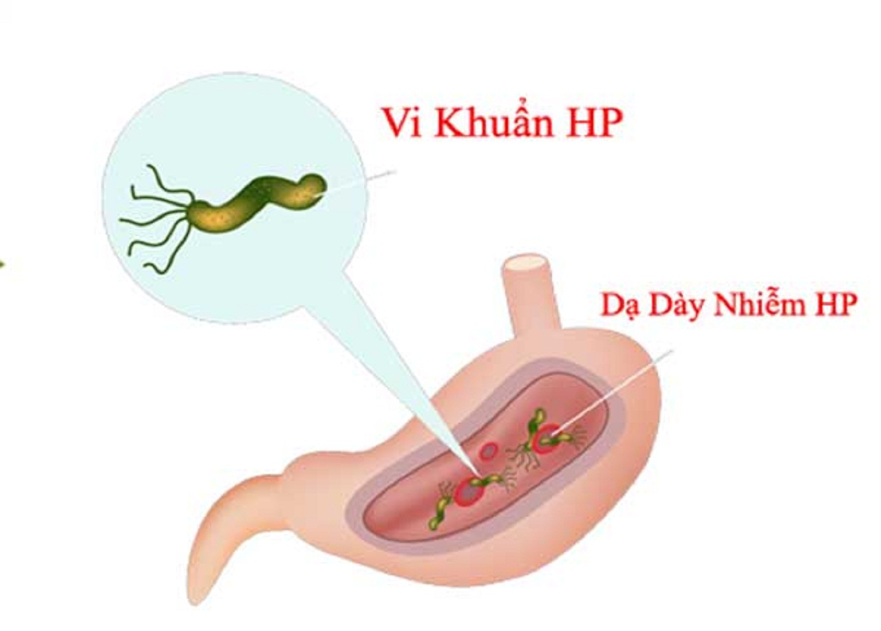 Vi khuẩn HP gây trào ngược acid dạ dày như thế nào?