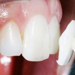 Dán Veneer răng – “Mặt nạ” hoàn hảo cho hàm răng khuyết điểm