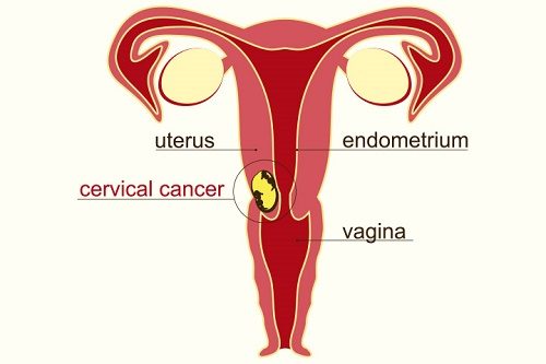 Ung thư cổ tử cung là bệnh ung thư phụ khoa thường gặp ở nữ giới