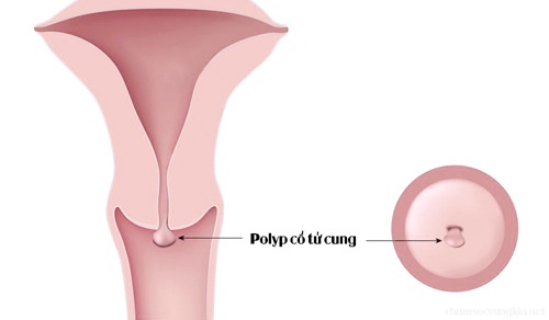 Đau bụng dưới sau khi quan hệ tình dục có thể do polyp cổ tử cung