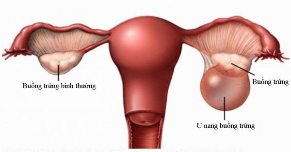 Ở nữ giới, đau hạ vị có thể là do u nang buồng trứng hoặc các bệnh lý phụ khoa khác