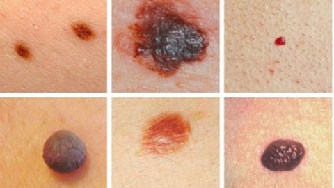 Dấu hiệu của bệnh ung thư da là gì?