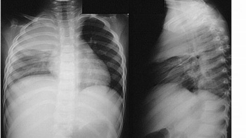 Biểu hiện của tràn dịch màng phổi