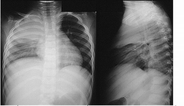 Biểu hiện của tràn dịch màng phổi | TCI Hospital