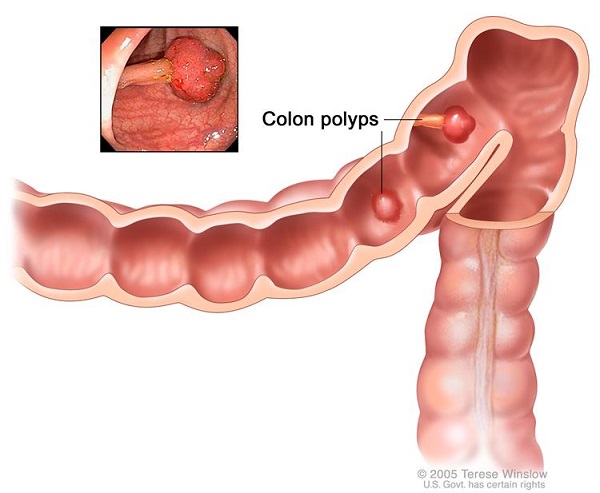 Polyp đại tràng (ruột già) là bệnh thường gặp và có thể dẫn đến những biến chứng nghiêm trọng nếu không được phát hiện, điều trị kịp thời