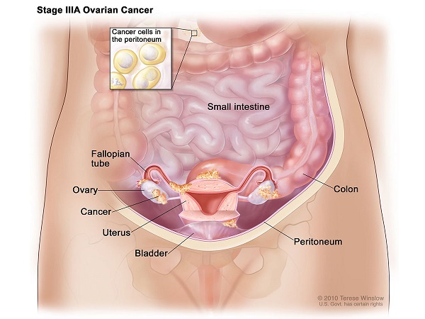 Ung thư buồng trứng giai đoạn IIIA