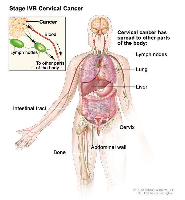 ung thư cổ tử cung giai đoạn IV