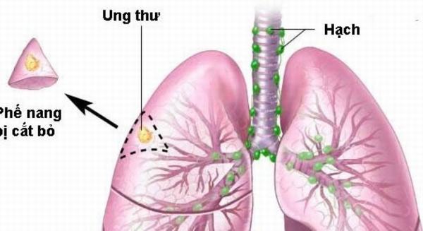 6. Phòng ngừa và tầm soát ung thư phổi di căn hạch