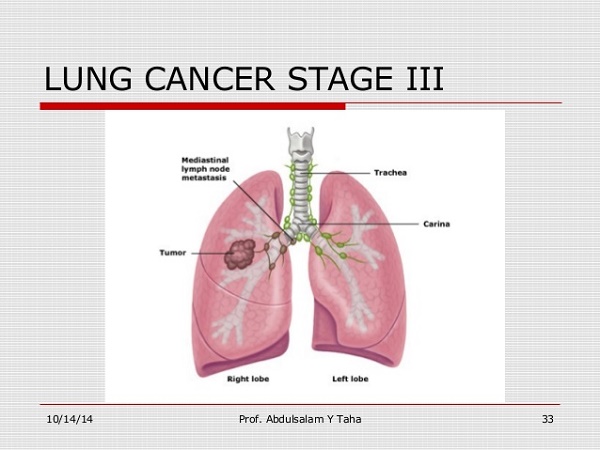 ung thư phổi giai đoạn 3