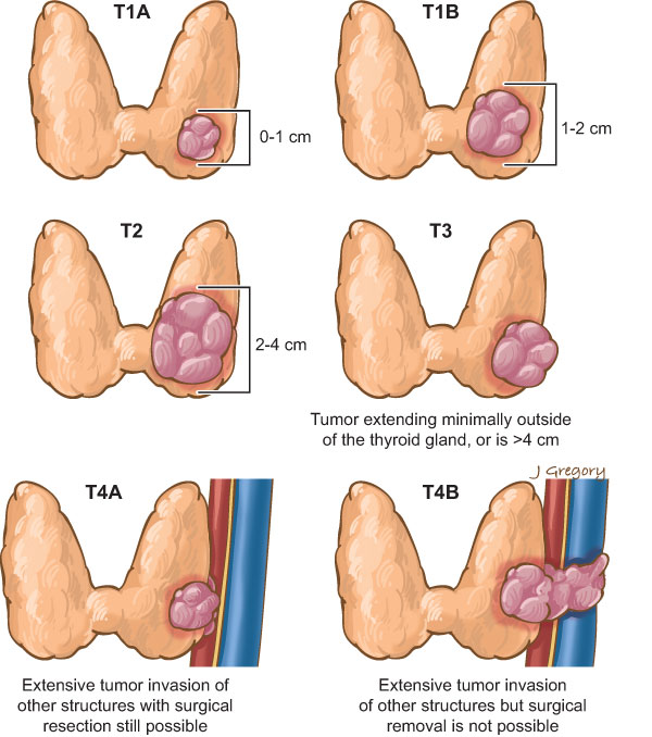 U Tuyến Giáp Giai Đoạn 3: Thông Tin Chi Tiết và Phương Pháp Điều Trị