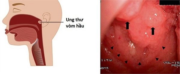 Dấu hiệu ung thư vòm họng tái phát