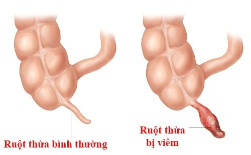 Viêm ruột thừa đặc trưng bởi hiện tượng tắc và ruột thừa bị viêm nhiễm.