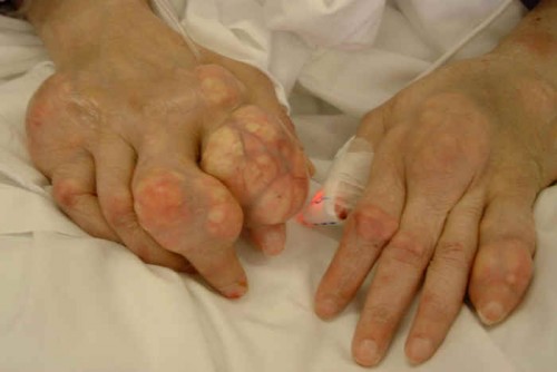 Bệnh gút ở tay có quá trình tổng hợp purine nội sinh ảnh hưởng như thế nào đến tình trạng acid uric trong cơ thể?
